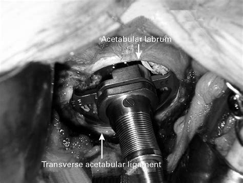 The Transverse Acetabular Ligament An Aid To Orientation Of The