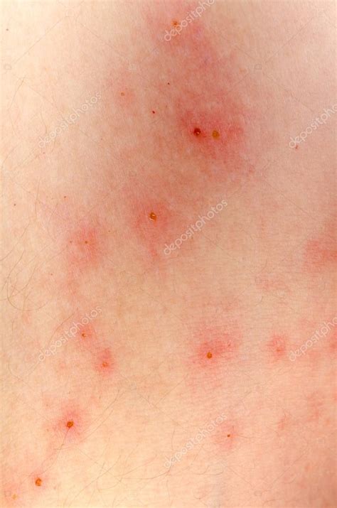 Allergic Rash Dermatitis Eczema Skin — Stock Photo © Panxunbin 17995651
