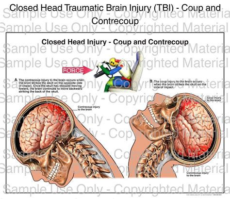 Understanding Closed Head Traumatic Brain Injuries