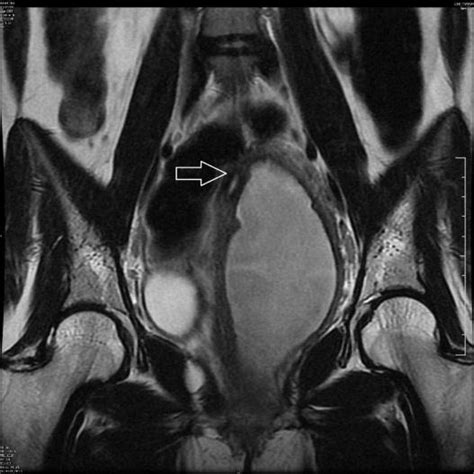 A Mri Pelvis Axial Image Uterus Didelphys Normal Endometrial