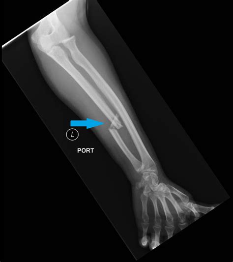 Monteggia Fracture In An Assault Patient Jetem