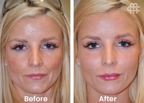 Honolulu Jawline Fillers And Facial Fillers For Lips Cheeks And Face