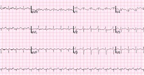 Dr Smiths Ecg Blog Right Sided Heart Failure And Tachycardia