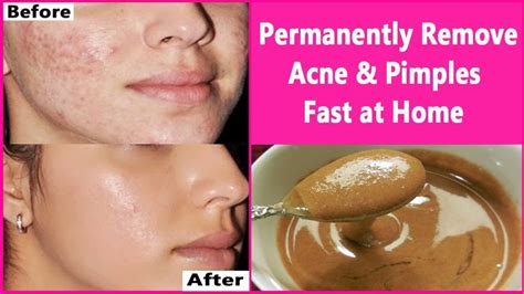 10 Easy Ways To Treat Acne And Pimples At Home 2024 Jaxtr