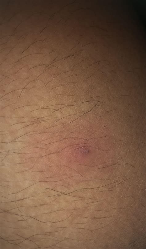 This Bump Appeared On My Inner Thigh Whats This Rskincareaddiction