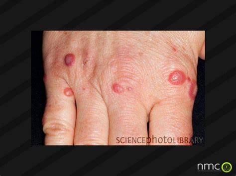 Torch Infections In Pregnancy Presentation