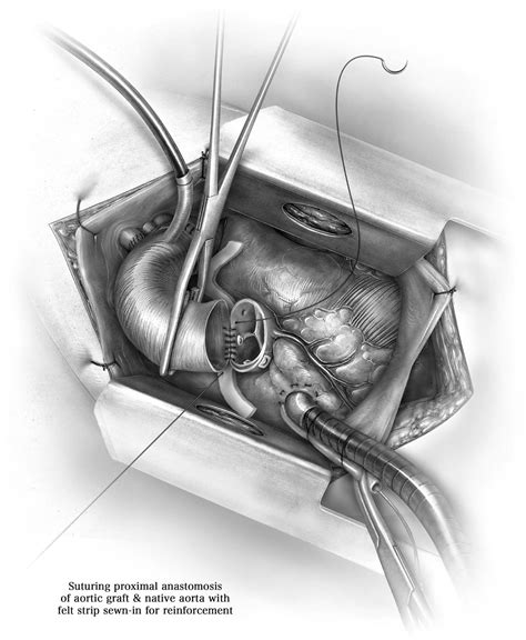 Aortic Root Reconstruction And Valve Repair During Acute Type A Aortic