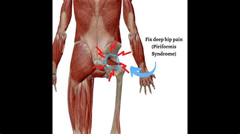 Piriformis Syndrome Deep Buttock Muscular Pain Symptoms Causes And