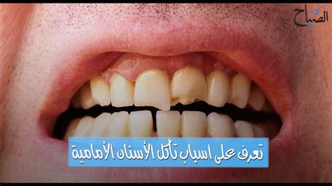 علاج تاكل الاسنان الامامية