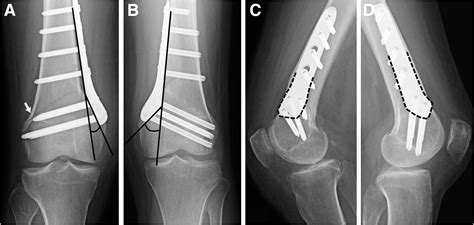 Medial Closed Wedge Distal Femoral Osteotomy Using A Novel Plate With
