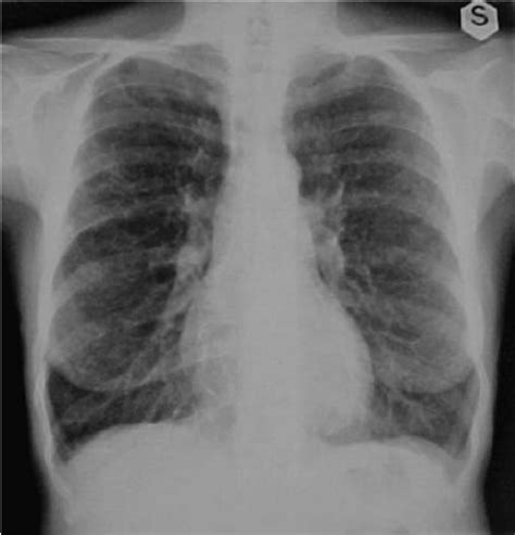 A Hrct Shows Extensive Cystic Lung Disease In Plch Note The