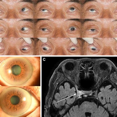 A 31 Year Old Healthy Male Patient Who Developed Diplopia And Ataxia At