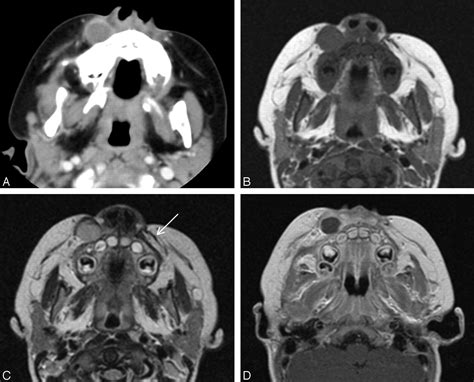 Nodular Fasciitis In The Head And Neck Ct And Mr Imaging Findings