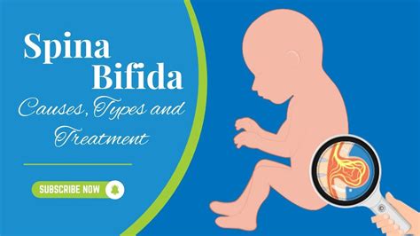 Spina Bifida Causes Types And Treatment Youtube