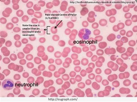 Haematology In A Nutshell Red Blood Cell Morphology