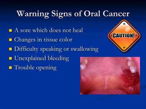 ppt oral cancer powerpoint presentation free download id 5349402