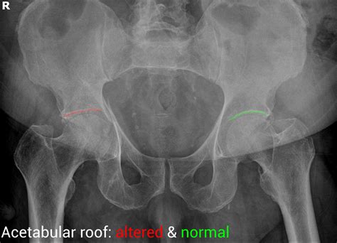 Acetabular Fracture Anterior And Posterior Columns Image