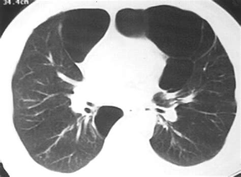 Usefulness Of The Double Wall Sign In Detecting Pneumothorax In