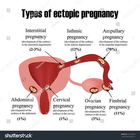 Types Ectopic Pregnancy Infographics Vector Illustration 库存矢量图（免版税