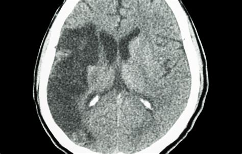 If a blood clot breaks away from plaque buildup in a carotid artery in the neck, it can travel to an artery in the brain. Statin Pretreatment Associated With Reduced Infarct Volume ...