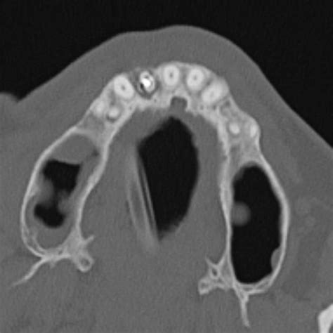 Periapical Cyst Radiology