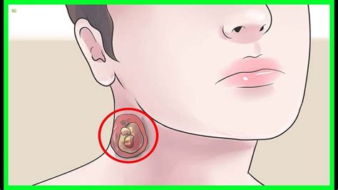 5 effective natural remedies to cure sebaceous cysts best home remedies youtube