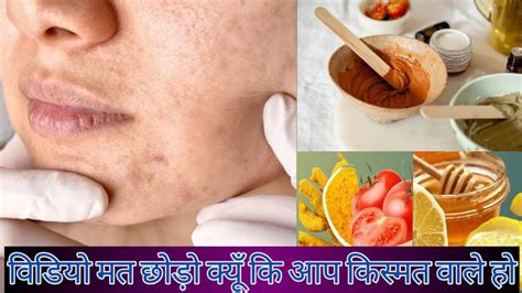 All Skin Problems 1 Day Solution चेहरे के दाग धब्बे झूरीयाॅ और