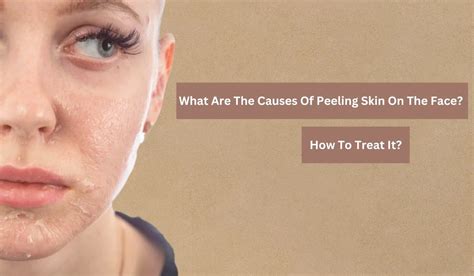 What Are The Causes Of Peeling Skin On The Face How To Treat It