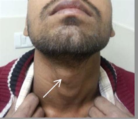 Midline Ectopic Thyroid Mimicking As A Thyroglossal Duct Cyst Manju