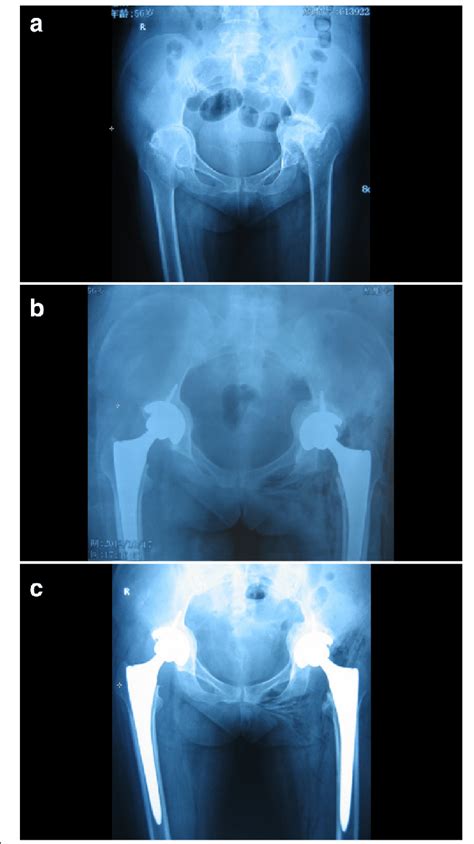 A A Bilateral Acetabular Protrusion Developing Secondary To Ra The