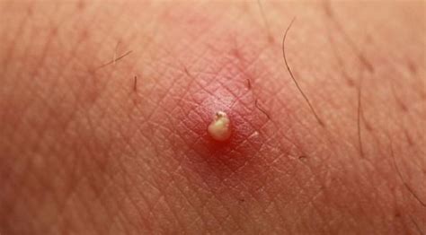 Vaginal Pimples Causes Treatments And Notes