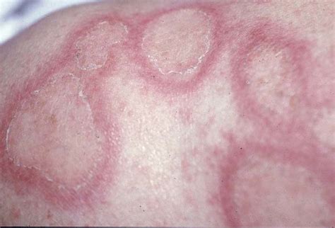 Cutaneous Lupus Erythematosus Causes Symptoms And Treatment