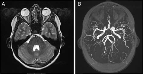 Magnetic Resonance Imaging And Angiography A T2 Weighted Transverse