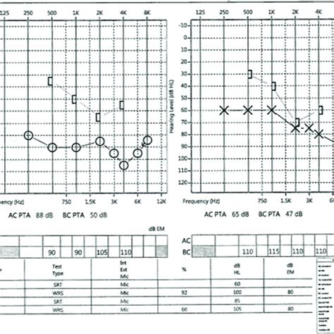 Audiogram Showing Sensorineural Hearing Loss Of The Right Ear Decreased