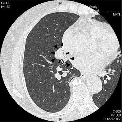 Chest Ct Showed A Solid 25 × 20 Cm Nodule In The Right Middle Lobe