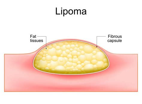 Lipoma Removal Procedure Recovery And Aftercare Tips For Patients