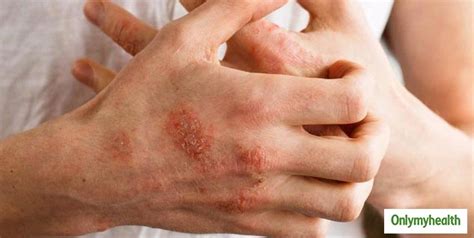 All About Seborrheic Eczema A Skin Condition Explained By