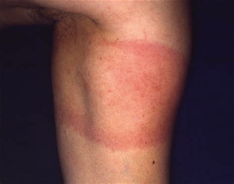 How Accurate Is A Clinical Diagnosis Of Erythema Chronicum Migrans
