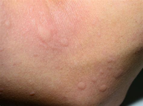 Symptoms Of An Iodine Allergy