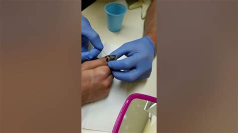 Popping A Blood Blister Warning Youtube