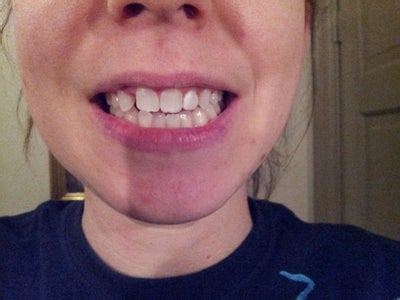 Here are some ways to close the teeth gap after braces: Can I fix this gap without braces? (photo) Dentist Answers ...