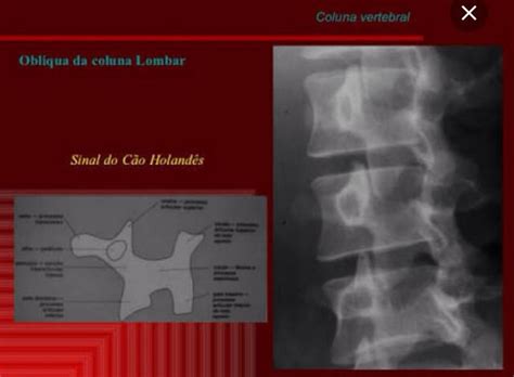 Incidência CL obl Coluna Lombar Radiologia
