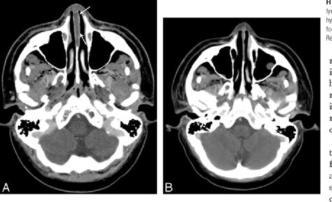 Figure From Nasal Septal Abscess In Patients With Immunosuppression Semantic Scholar