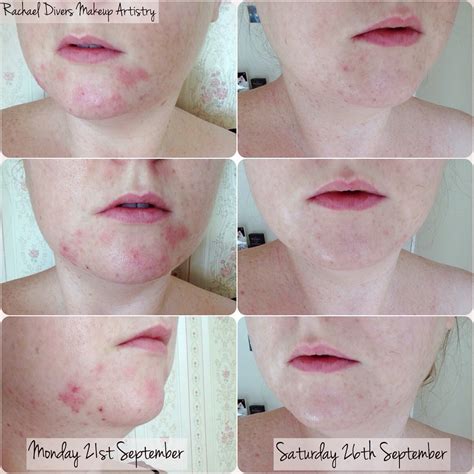 My Experience With Erythromycin For Acne Rachael Divers