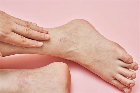 What Should You Know About Veins That Are Bulging Swollen Or Painful
