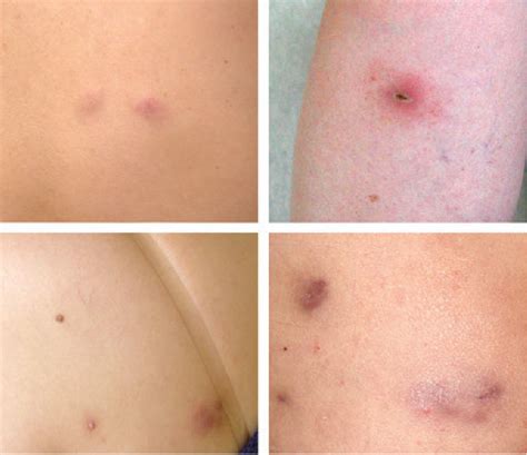 An Outbreak Of Skin And Soft Tissue Infection Caused By Mycobacterium