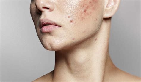 Skin Blemish Removal Islington Warts And Mole Removal London