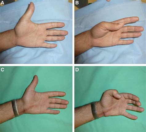 Case Example Of Patient Number 3 38 Year Old Man Who Had A Rupture Of Download Scientific