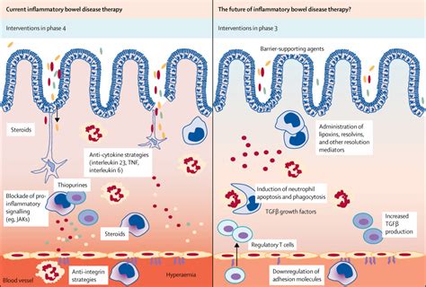 Resolution Of Inflammation In Inflammatory Bowel Disease The Lancet