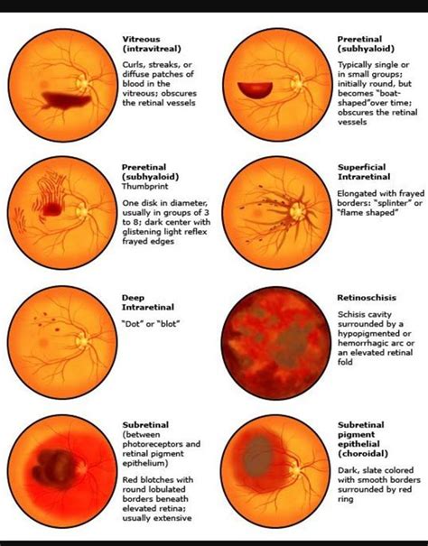 Fundoscopy Eye Facts Eye Anatomy Medical Knowledge